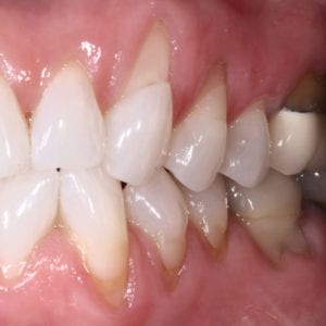 Smile Gallery - East Tennessee Periodontics - Dr. Robert Cain